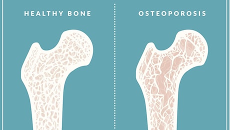 Osteoporosi, come difendersi dalle ossa fragili