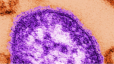 Il caso di Beata Halassy, la virologa che ha sperimentato una terapia a base di virus sul proprio tumore al seno